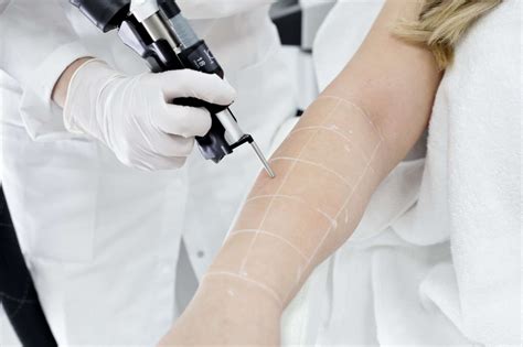 Laserontharing Gentle Skin Clinic