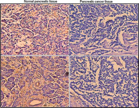 Decreased Gd3 Expression In Human Pancreatic Cancer Tissue A