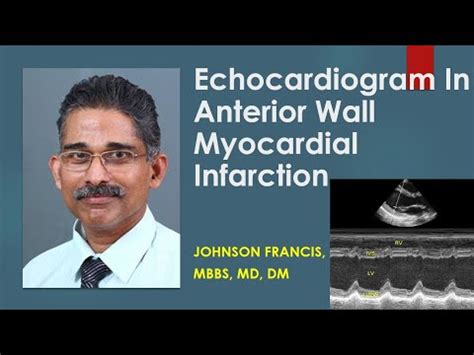 Blood tests to check for infection. Colour Doppler echocardiogram in anterior wall myocardial infarction (AWMI) - YouTube