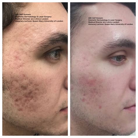 Acne Scar Laser Treatment And Removal London Dr H Consult