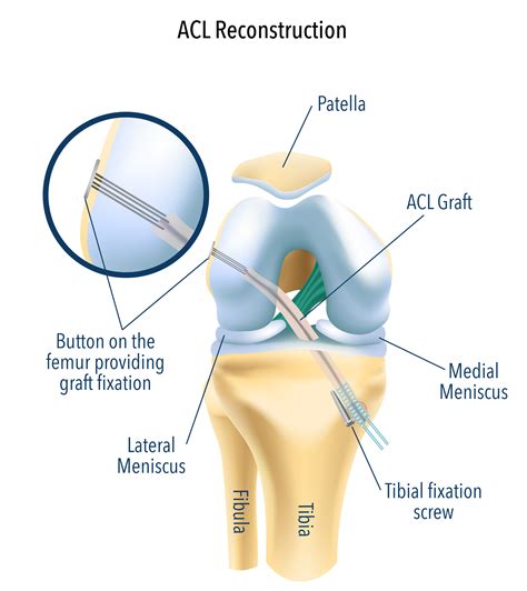 Acl Reconstruction Pictures Long Term Effects Of Acl Reconstruction Surgery Regenexx Acl
