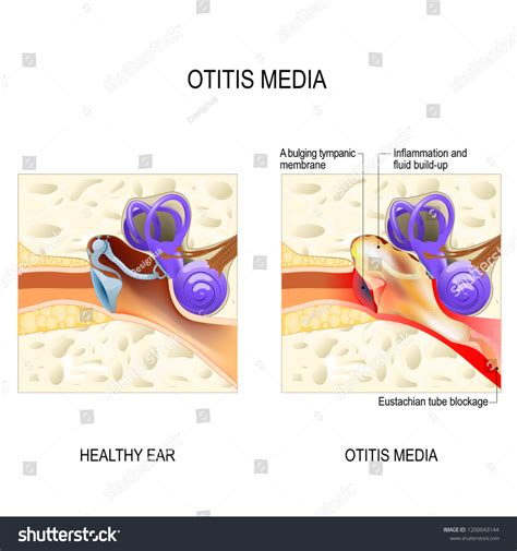 Otitis Media Inflammatory Diseases Middle Ear Ilustración De Stock