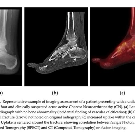 Spect Ct In The Early Diagnosis Of Charcot Arthropathy Df Blog