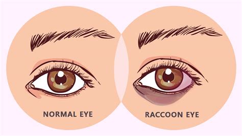 Raccoon Eyes Condition Its Symptoms Causes Complications And More