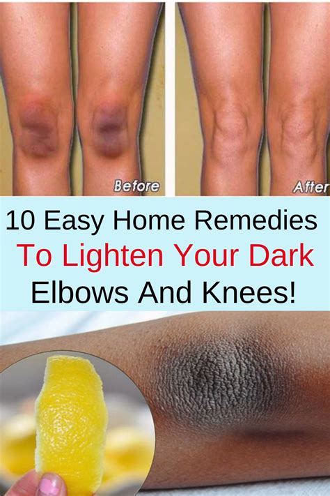 10 Easy Home Remedies To Lighten Your Dark Elbows And Knees In 2021