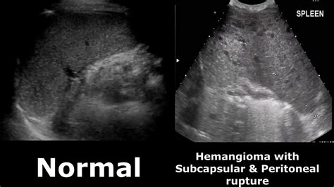 Spleen Ultrasound Normal Vs Abnormal Image Appearances Comparison