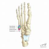 Here you may to know how to heal a jones fracture faster. Common conservatively managed fractures? - EMCAGE.net