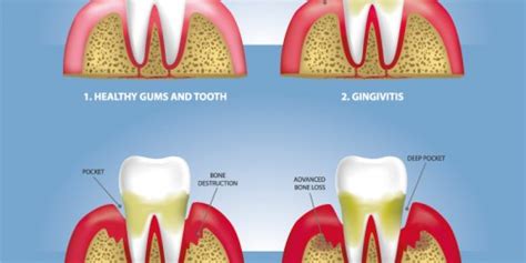 Raised Bump On The Gum After Tooth Extraction Oral And Dental Health