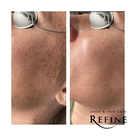 Before And Afters Refine Laser And Skin Care Chanhassen Minnetonka