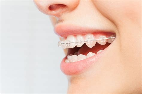 What You Need To Know About Getting Braces As An Adult