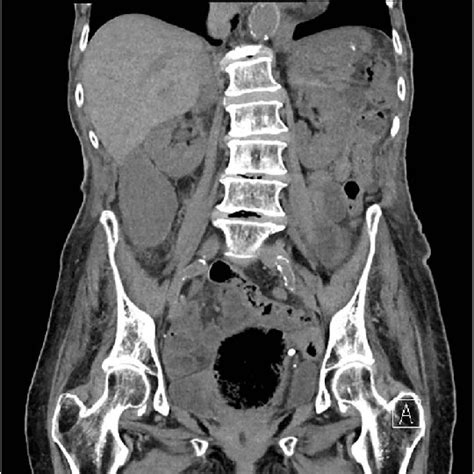 Axial Slice Of Non Contrast Ct Abdomen And Pelvis Demonstrating A