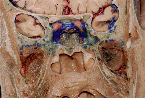 Anterior View of the Face in Coronal Section at the Sphenoid Sinus