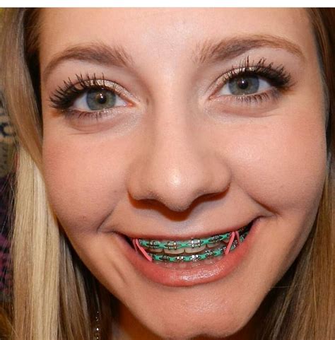 What Are The Best Color For Braces Jiwa Jejaka Jawa