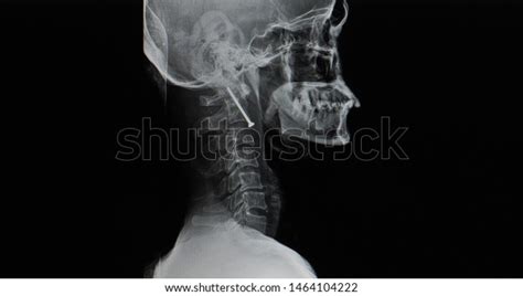 Lateral Projection Xray Cervical Spine Showing Stock Photo 1464104222