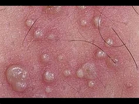 Herpes simplex virus infection in pregnancy and in neonate: Herpes Simplex 1 Symptoms | Herpes Simplex 1 Transmission ...