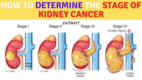 How To Determine Stage Of Kidney Cancer Treatment Kidney Cancer