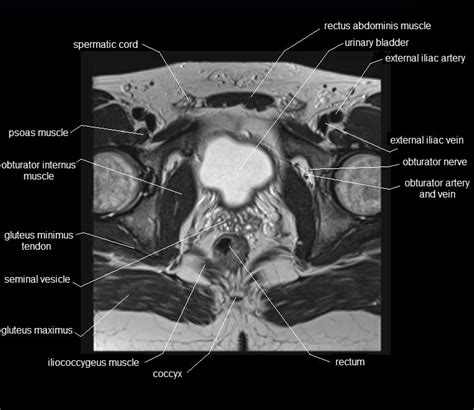 The pelvis is a symmetrical bony ring interposed between the vertebrae of the sacral spine and the lower limbs, which are articulated through complex joints, the hips. MRI pelvis anatomy | free male pelvis axial anatomy