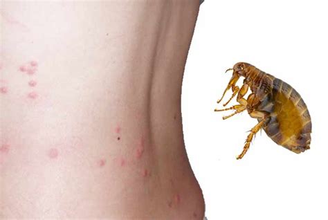 How Long Do Flea Bites Last Pestbugs