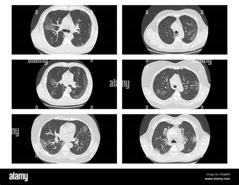 X Ray Findings Of Patients With Covid 19 Pneumoniacomputed Tomography