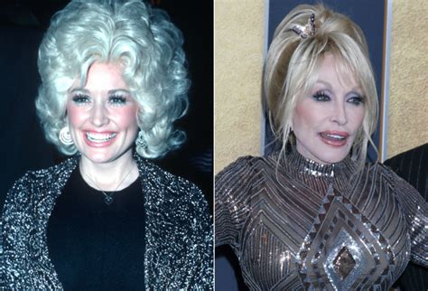 Dolly Partons Plastic Surgery All The Procedures Shes Gotten Over