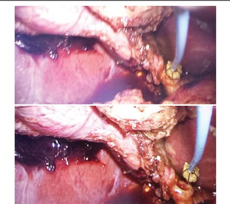 Figure From Laparoscopic Common Bile Duct Exploration For
