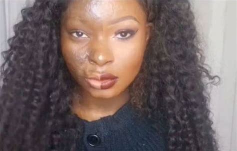 It May Seem Unbelievable But This Woman Has Burn Scars All Over Her Face 8 Pics
