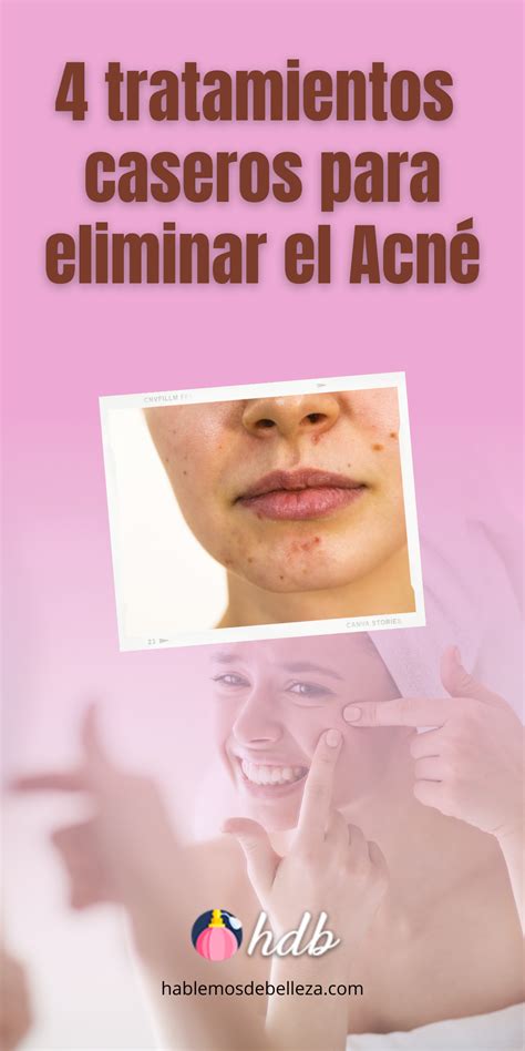 4 Tratamientos Caseros Para Eliminar El Acné Remedios Para El Acne