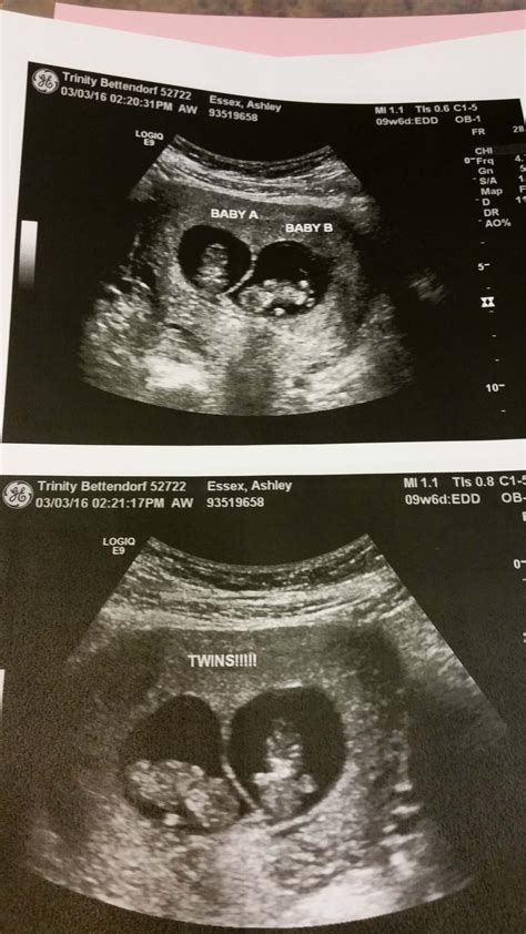 Weeks Pregnant With Twins Belly Symptoms Ultrasound Pictures My Xxx