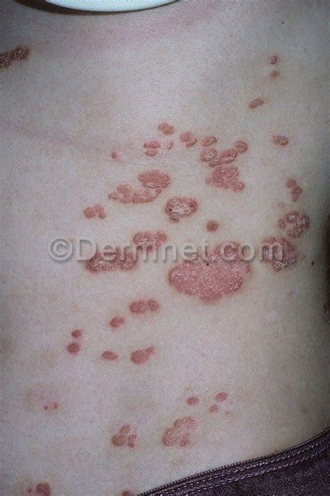 Psoriasis Chronic Plaque Psoriasis Skin Disease Pictures Diseases