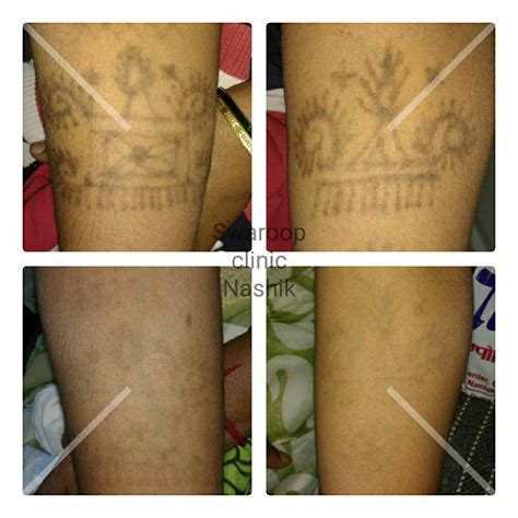 Discover 67 Permanent Mark Tattoo Latest In Cdgdbentre