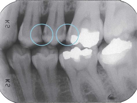Radiographs And Caries Interpretation Of Dental Caries Dhyg 103