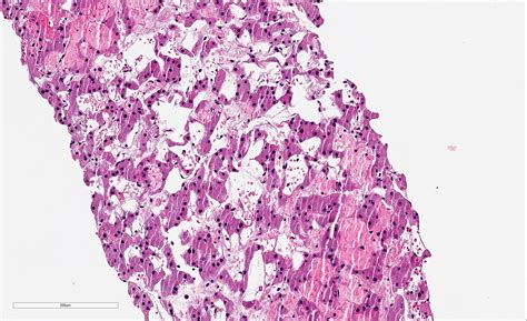 Pathology Outlines Oncocytoma