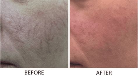 Vessel Removal Bismarck Nd Pure Skin Aesthetic And Laser Center
