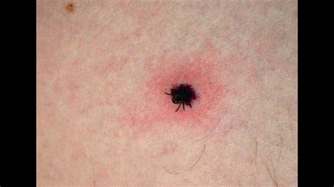 How To Remove A Tick Head All You Need Infos