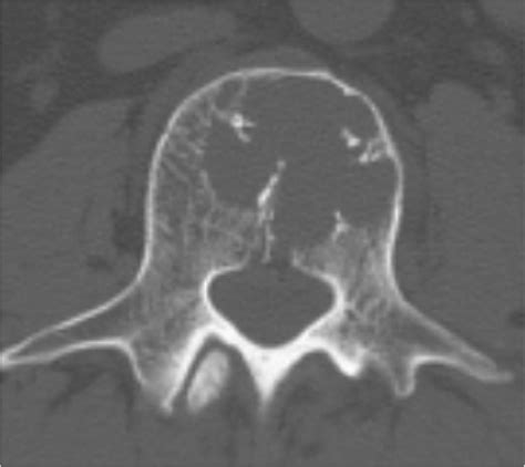 Preoperative Computed Tomography Scan Reveals Osteolytic Lesions In The