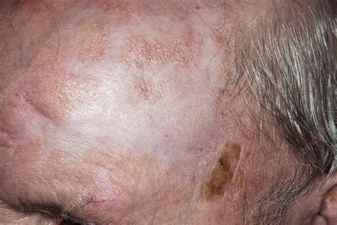 Scarring In Solar Keratosis Stock Image C0234353 Science Photo