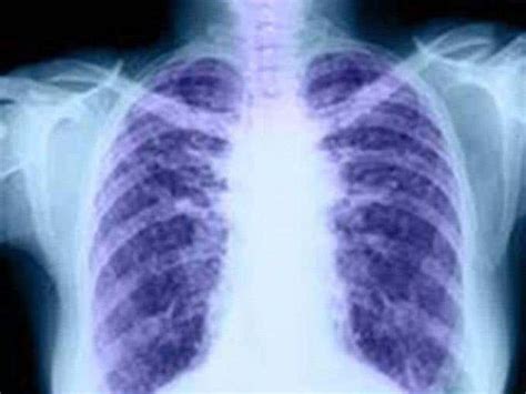 Ct Scanning Detects Early Signs Of Lung Cancer In 70 Of Cases Study