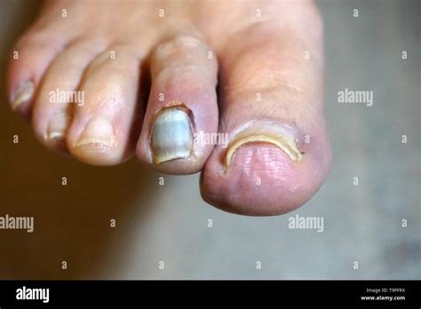 Broken Toe And Smashed Toenail Stock Photo Alamy