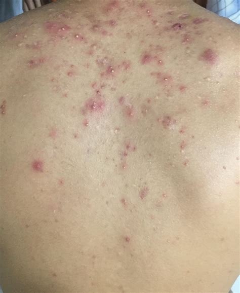What Is This On My Back Is This Fungal Acne Rdermatologyquestions