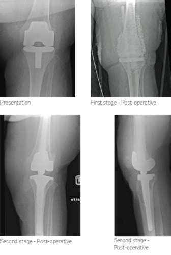 Revision Total Knee Arthroplasty Biocomposites