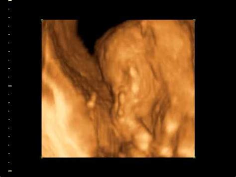 Ssw wird das baby sofort auf die neugeborenenstation verlegt oder auf die intensivstation gebracht. 4D ultraschall in der 21. ssw - YouTube