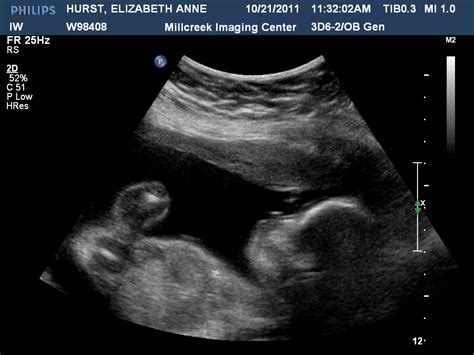 Still, it's helpful to understand the process of your baby boy's development so you know what to expect from the photos or just when visualizing the general stages of his growth. The Hurst Family: Some Ultrasound Pics of our Baby Boy