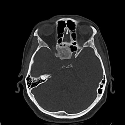Ultimate Radiology Case Of The Day Sclerotic Sphenoid Lesion