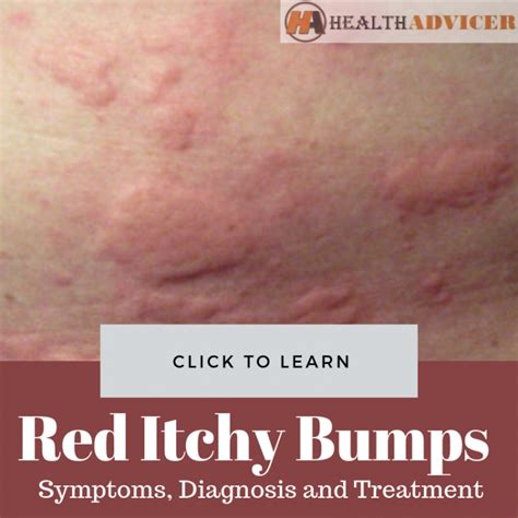 Red Itchy Bumps On Skin Causes Treatment Pictures Minhhai D Help