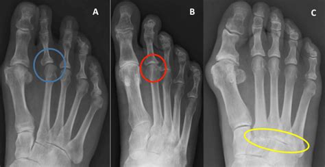 Big Toe Arthritis Hallux Rigidus The London Foot And Ankle Clinic