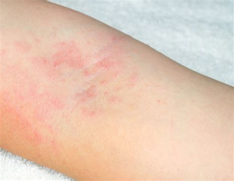 Rashes And Their Causes Sacramento Ca Emil A Tanghetti Md