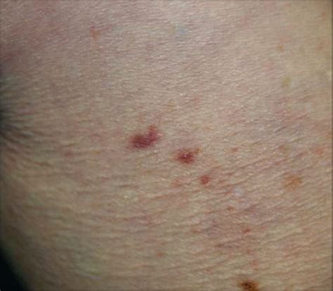 Multiple Asymptomatic Violaceous Macules On The Thigh—quiz Case