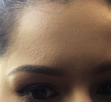 How I Helped Clear Forehead Bumps Subclinical Acne How To Get Rid