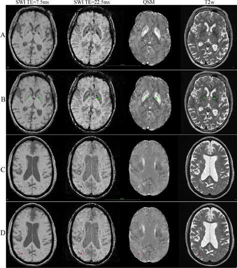 This Figure Shows Examples Of Cerebral Microbleeds And Basal Ganglia