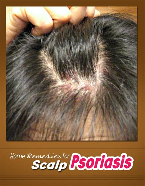 Psoriasis is a chronic condition, and the goal of treatment is to stop skin cells from growing so rapidly, according to mayo clinic. Home Remedies for Scalp Psoriasis | Dry scalp remedy ...